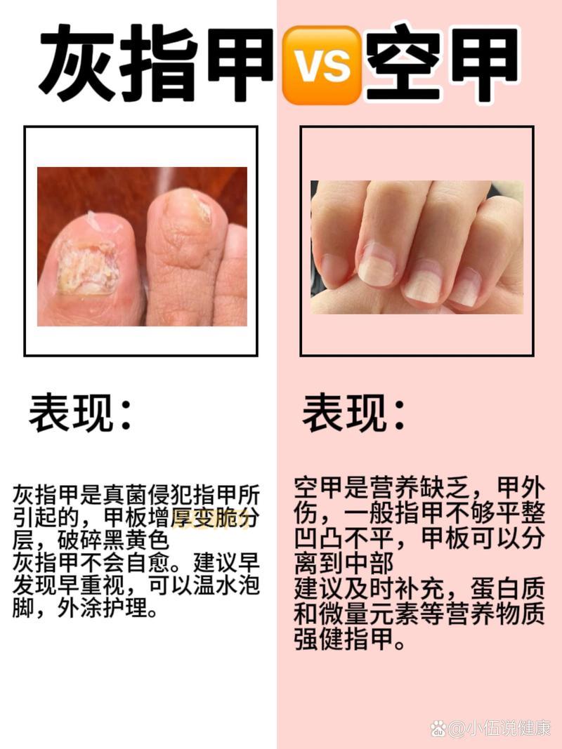 硬甲皮是什么？这几个原因你一定要知道！